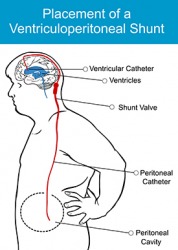 Shunt Dictionary Definition Shunt Defined